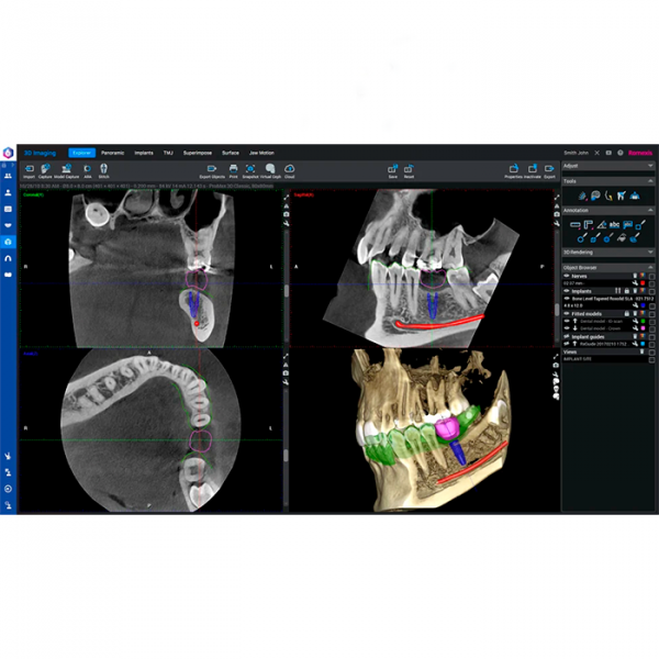 Romexis 3D Implant